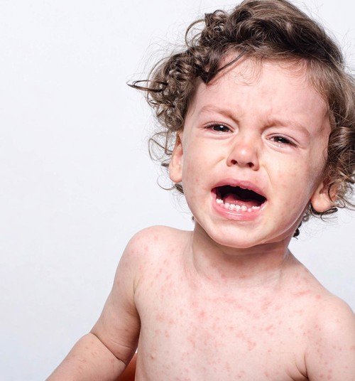 Leetrite põdemine nõrgestab immuunsust