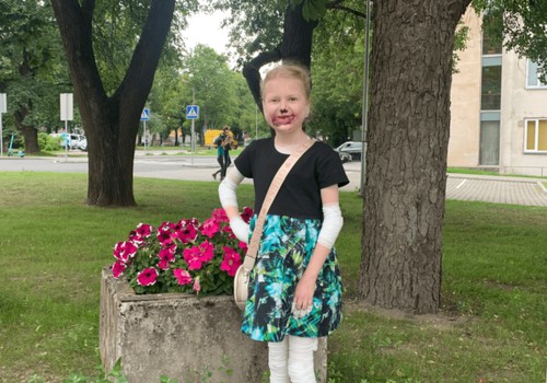 ÜKS MILJONIST! Heade annetajate abi vajab Cassandra, kes põeb Eestis ainsana üliharuldast nahahaigust