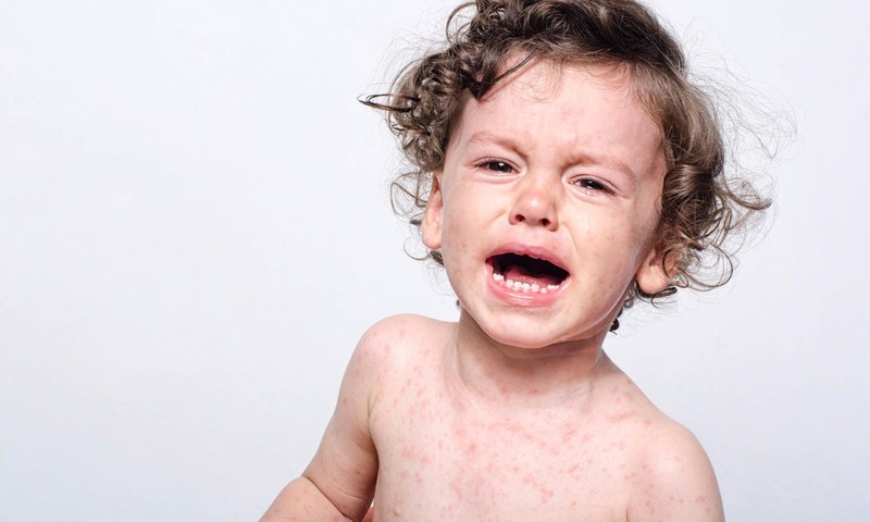 Leetrite põdemine nõrgestab immuunsust