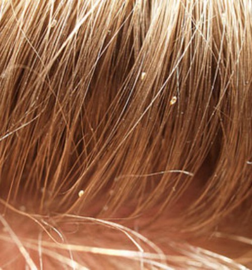 Täide leviku vältimiseks tasub enne kooli algust lapse juukseid kontrollida